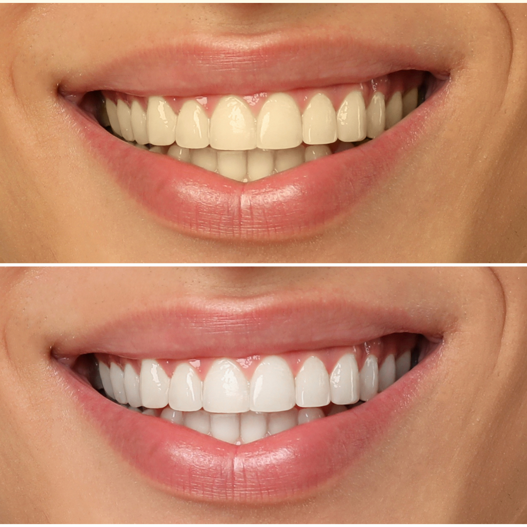 Teeth Whitening Andheri East